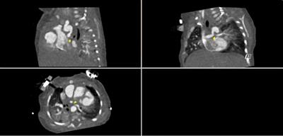 Case Report: Catheter-based mechanical thrombectomy using the Indigo aspiration system in a case of systemic-to-pulmonary shunt thrombosis